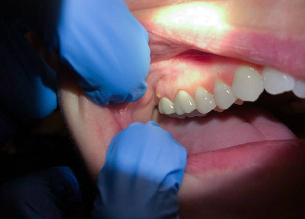 Best Emergency Wisdom Teeth Removal in Machias, WA